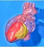 Cardiopatía Isquémica